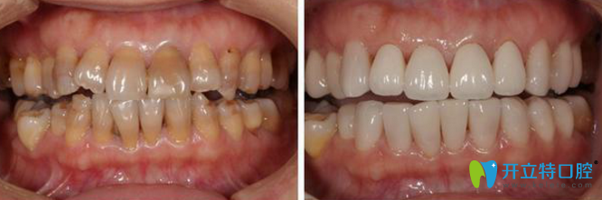 治疗前后牙齿对比照