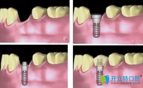 微创种植牙手术过程