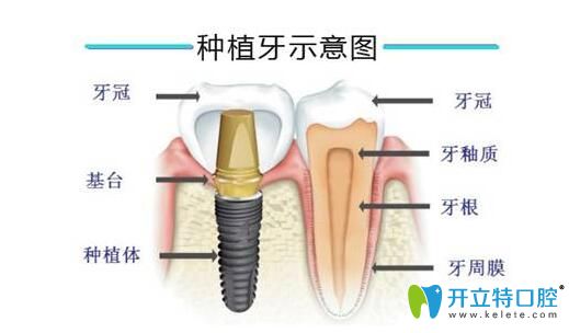 种植牙的过程示意介绍