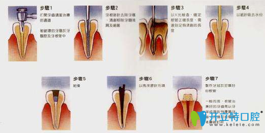 修复治疗牙齿