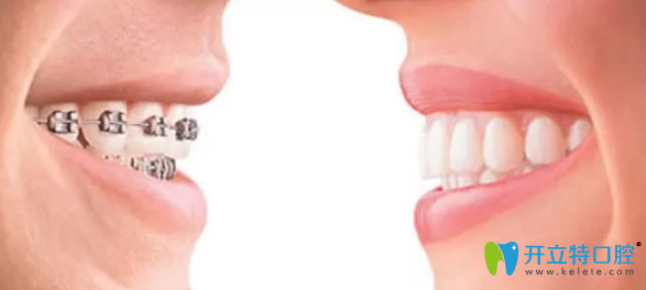 榆林长虹口腔医生为你辟谣：牙齿矫正是不是必须要拔牙？