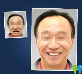 厦门宏沅膛口腔种植牙前后效果对比图