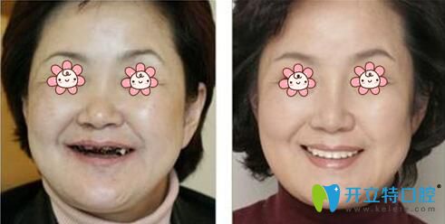 沈阳康贝佳口腔“即刻用”种牙案例