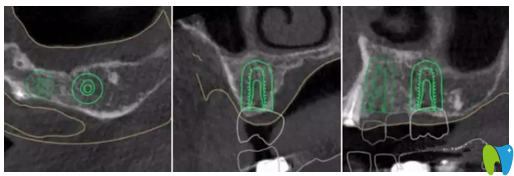 种植牙术前左上6牙位模拟种植图