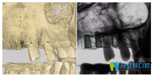 种植牙口内3D图拍摄