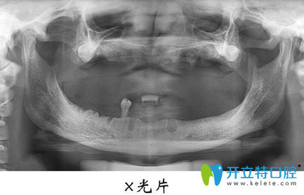 宏沅膛口腔种植牙前X光片