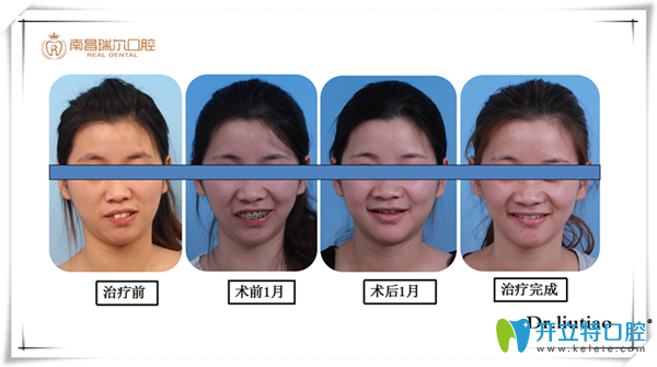 中线不齐伴前突真人案例 中线不齐伴前突真人案例