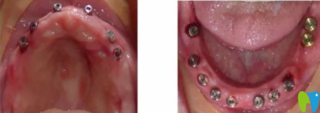 60岁老人在宏沅膛口腔做满口牙种植手术中