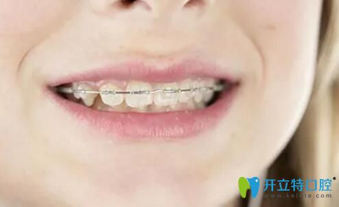 牙齿畸形矫正过程