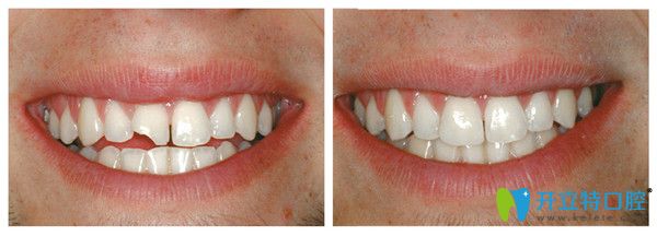 3M树脂修复缺损牙齿