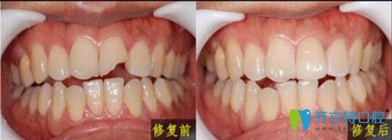 牙齿美学修复前后对比