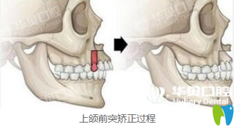 华贝口腔上颌前突矫正过程