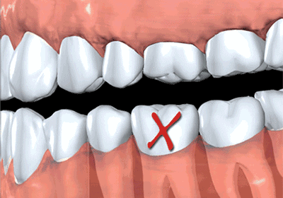 牙齿脱落不修复的后果