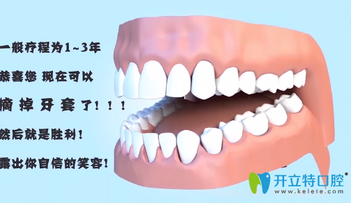 牙齿矫正需要多长时间及去牙套图