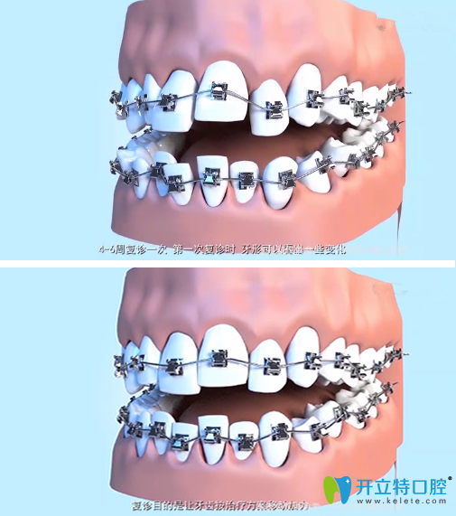 牙齿正畸复诊时间及变化过程
