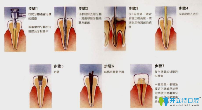 牙体牙髓治疗的过程