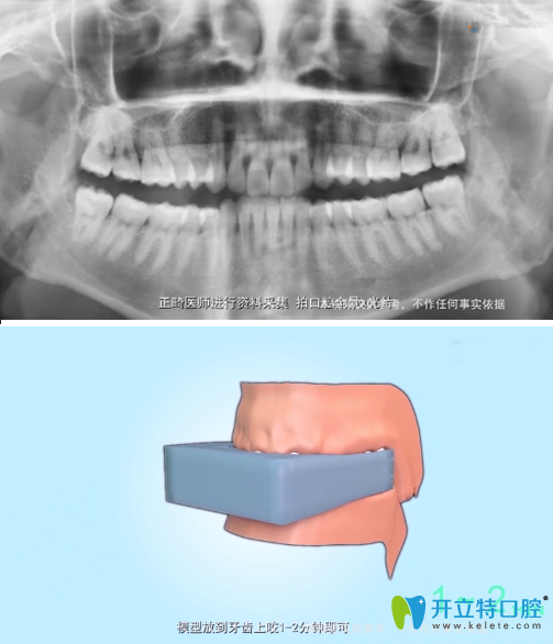 牙齿正畸前拍摄X光片及建立模型