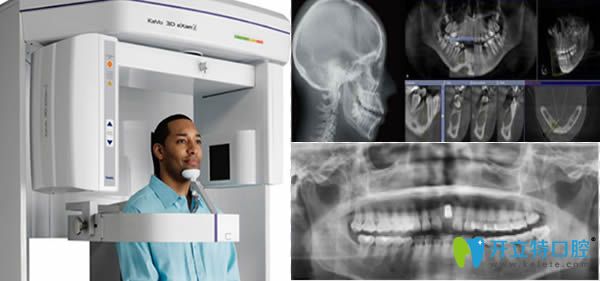 德国卡瓦3D全景CT机种植牙设备