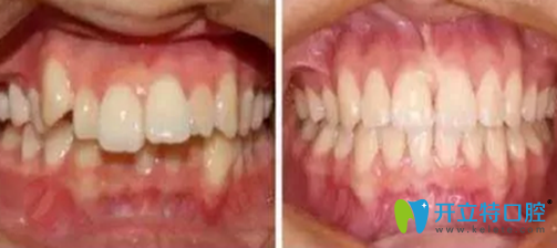 <!--<i data=20240703-sp></i>-->口腔牙齿矫正术前术后对比案例