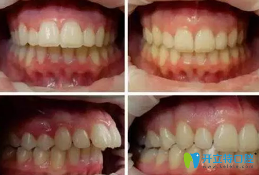 <!--<i data=20240703-sp></i>-->口腔龅牙隐形矫正案例前后对比图