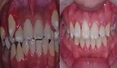 汉中小虎牙口腔儿童正畸什么时候做？看九岁儿童牙齿正畸案例及效果展示