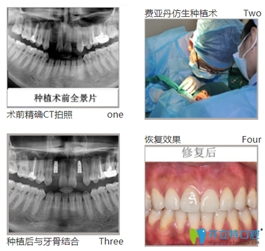 黎强给口牙缺失、牙槽骨萎缩幻阵采用德国费亚丹种植技术种牙过程图