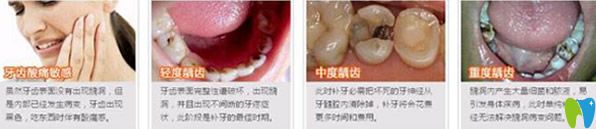 牙齿有个洞要补吗 补牙的方式有哪些 补一颗牙价格多少钱