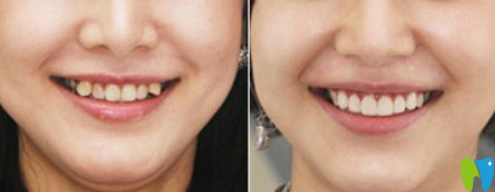 厦门齿度口腔牙齿矫正前后效果对比图