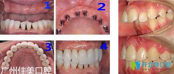 广州佳美口腔牙齿种植+龅牙矫正效果对比图