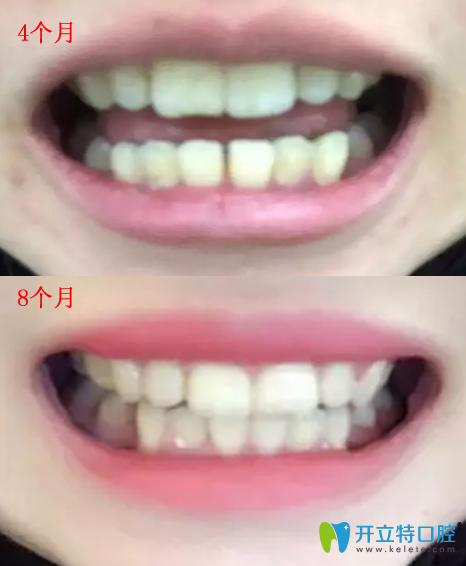 深圳唐健口腔牙齿矫正4-8个月变化过程图