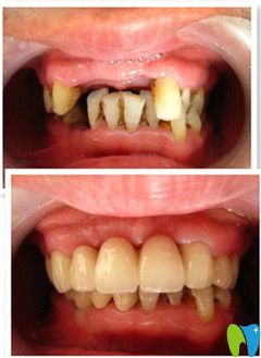 威海舒好王医生牙体缺失修复案例对比图
