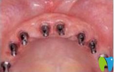 种植牙齿前先让种植体固定在牙槽骨内