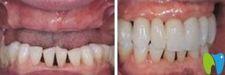 广州佳美口腔牙齿种植前后效果对比图