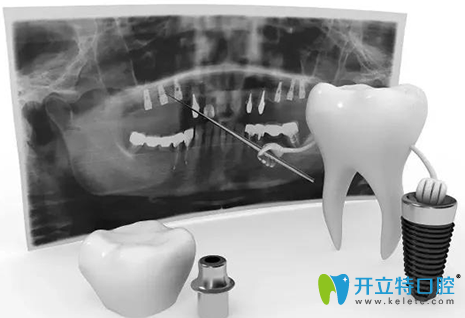 齿度口腔牙齿种植术前检查图