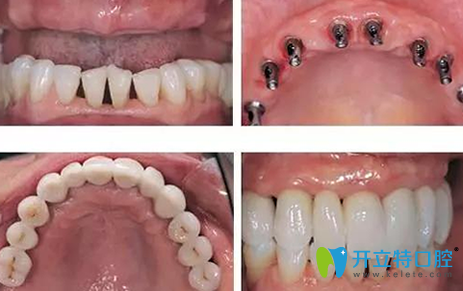 厦门齿度口腔牙齿种植前后效果对比图