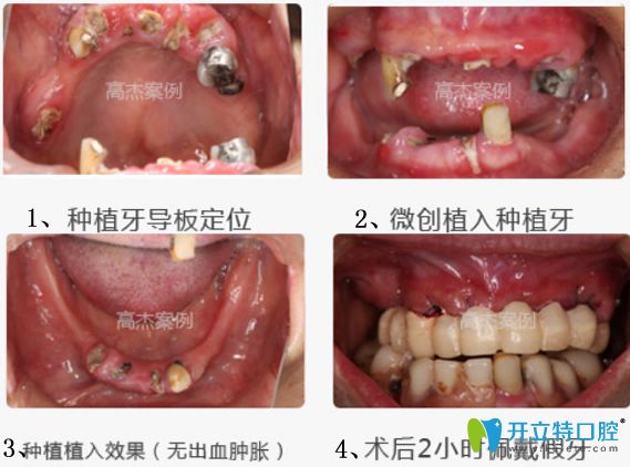 北京科瓦齿科上半口牙缺失患者修复案例