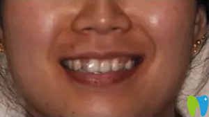 北京西尔口腔隐适美牙齿矫正前照片