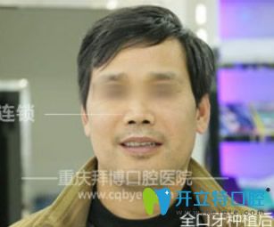 重庆拜博口腔即刻种植牙效果