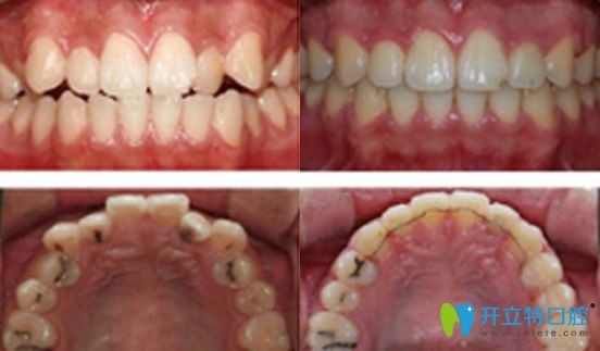 太平洋口腔牙齿错頜真人案例对比图