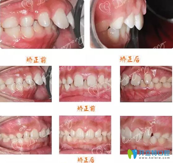 北京科瓦齿科罗罡儿童牙齿矫正案例