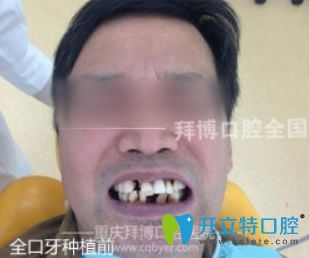 重庆拜博口腔牙齿种植前