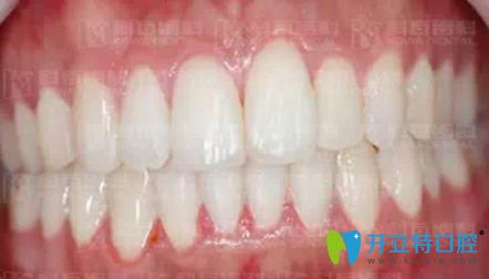科瓦齿科7个月牙齿矫正结束效果图展示