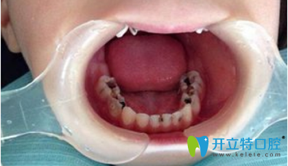 5岁儿童大牙有四颗龋齿要不要补 用3M树脂材料补牙怎么样