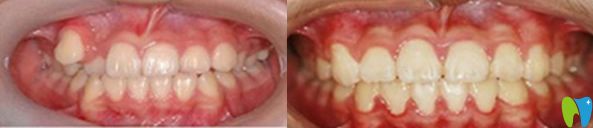 太平洋口腔牙齿矫正前后对比图