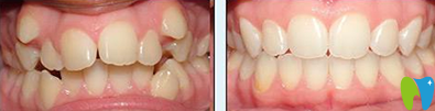 北京西尔口腔牙齿矫正术前术后效果对比图