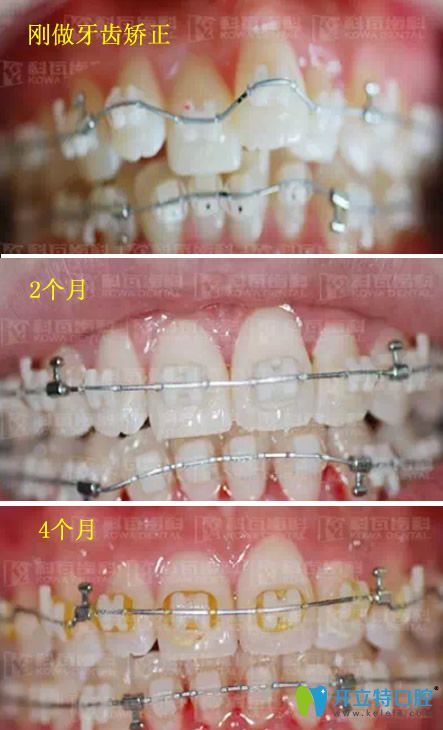 北京科瓦口腔牙齿矫正过程变化图