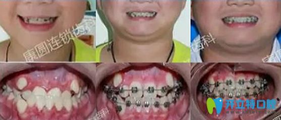 广州康圆口腔90天牙齿排齐案例