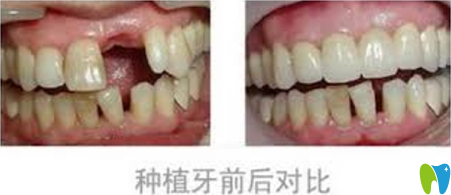 青岛可恩口腔种植牙前后效果对比图 青岛可恩口腔种植牙前后效果对比图