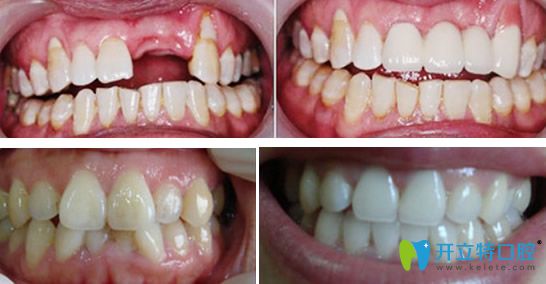 瑞尔齿科种植牙和牙齿矫正效果案例
