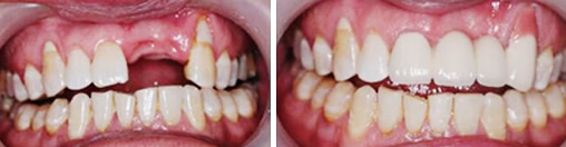 深圳瑞尔齿科种植牙案例为您展示：种牙过程分为几个步骤